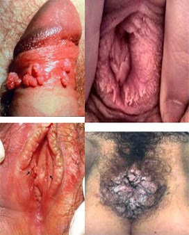 Illustration for article titled Penyembuhan Kutil Di Bibir Vagina | Penyakit Kelamin Kutil